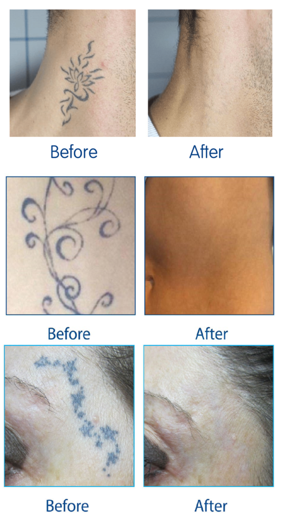tattoo removal leicester
